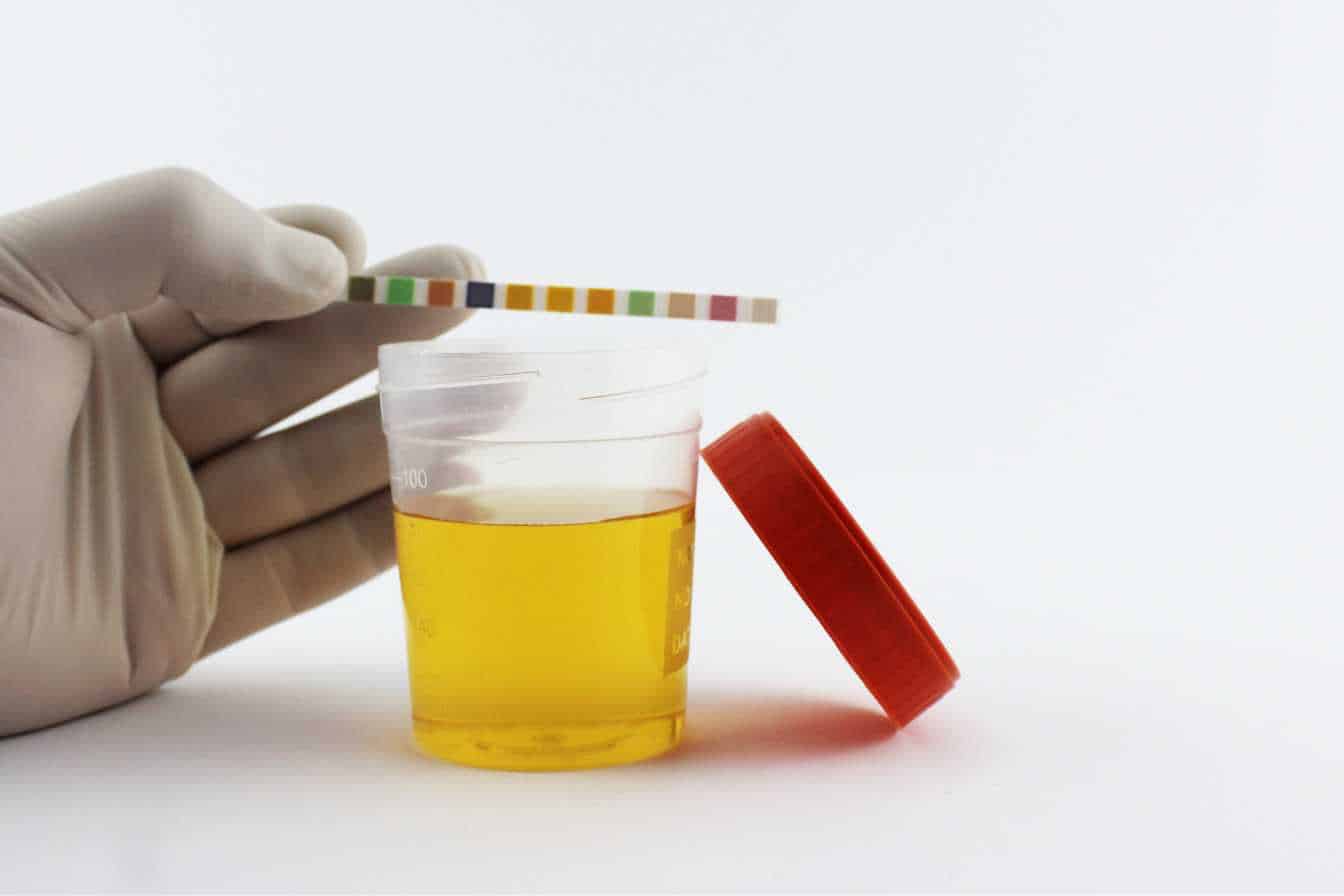 cellules-epitheliales-urines-2