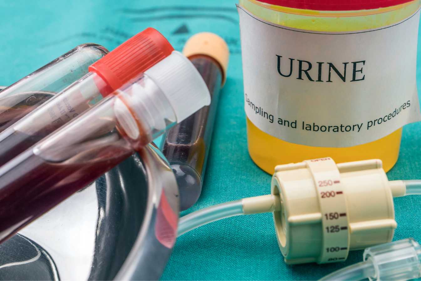 cellules-epitheliales-urines-3