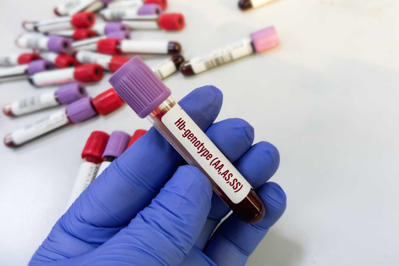 comment faire baisser l hemoglobine glyquee 1