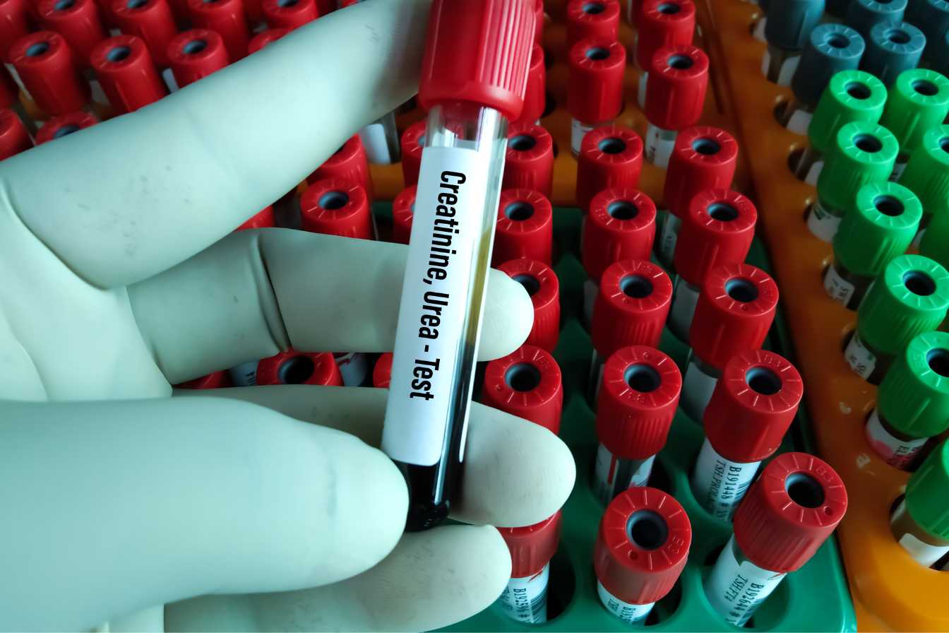 creatinine-prise-de-sang-3