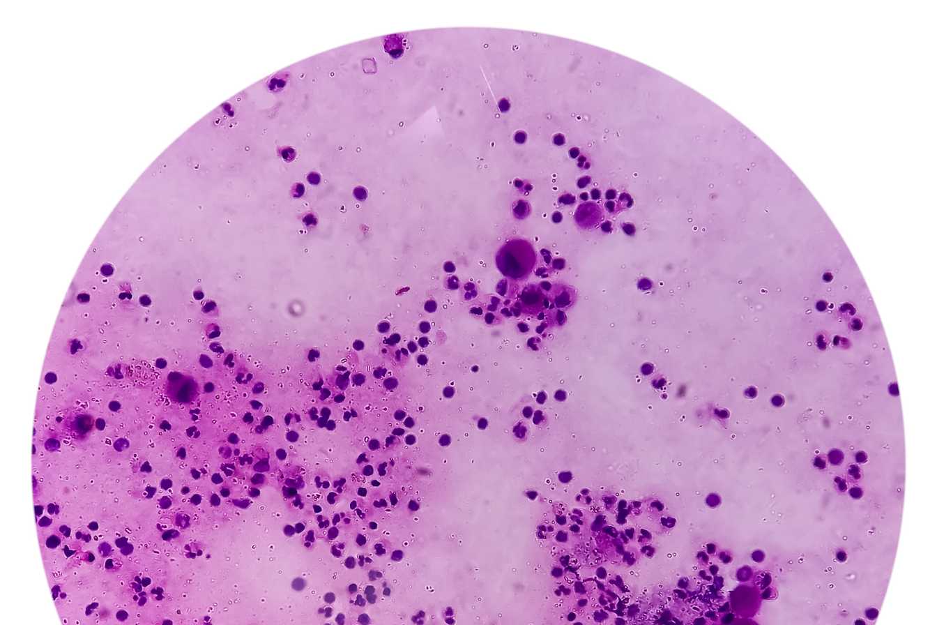 cytologie urinaire 1