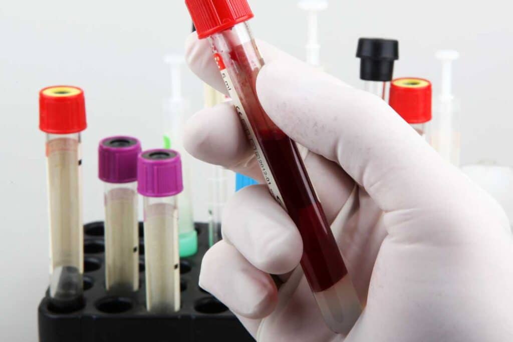 Gamma gt prise de sang : tout savoir sur les causes, symptômes et