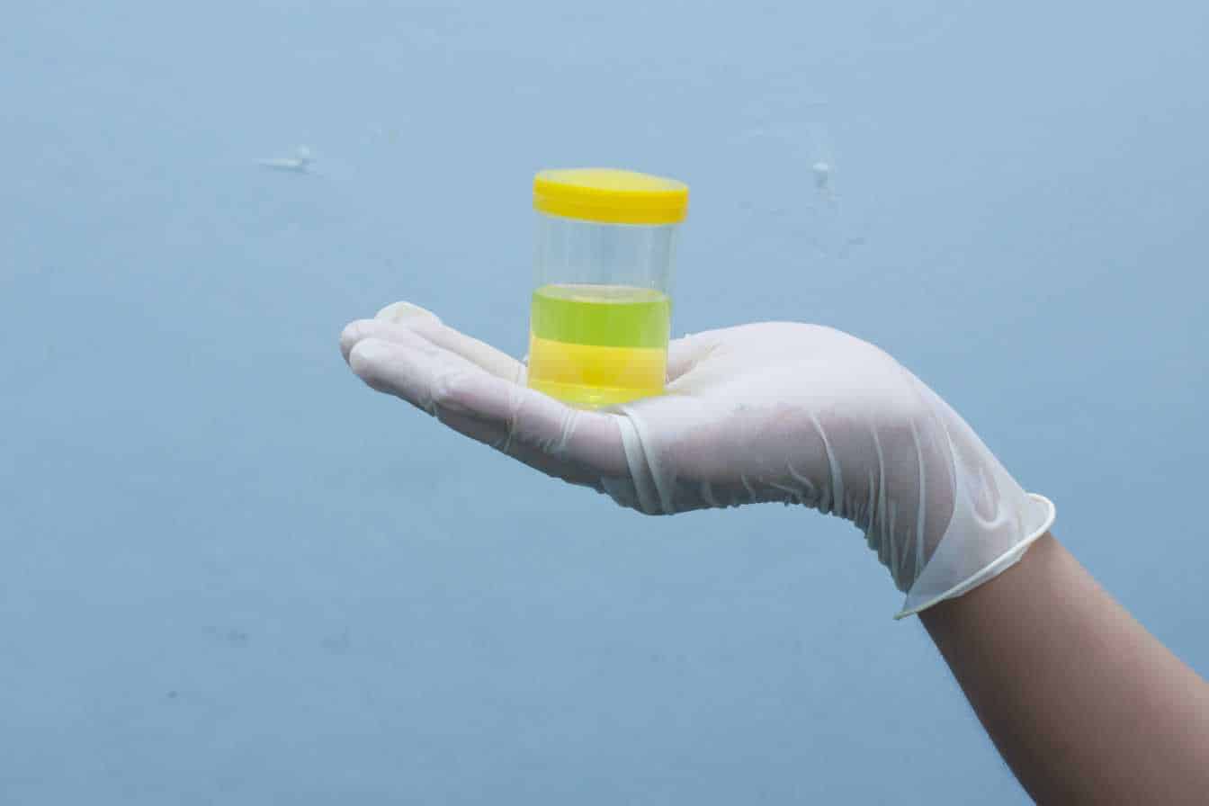 sang-dans-les-urines-hematurie-causes-diagnostic-et-traitements-2
