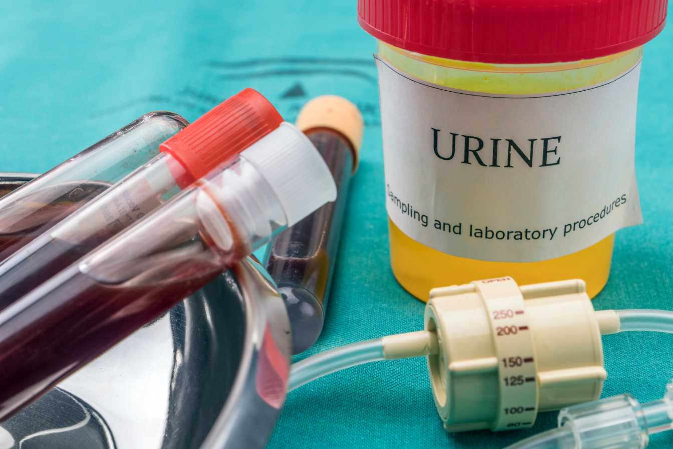 sang-dans-les-urines-hematurie-causes-diagnostic-et-traitements-3